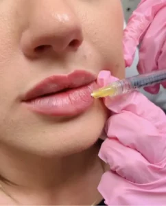 Lip Flip or Lip Filler? Which is Best for You?